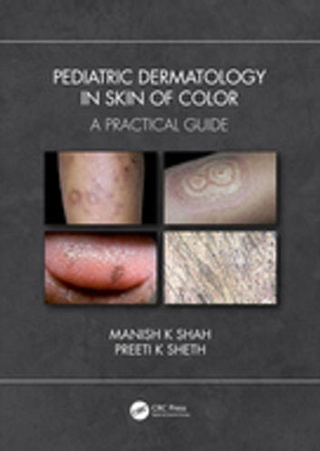 Pediatric Dermatology in Skin of Color: A Practical Guide